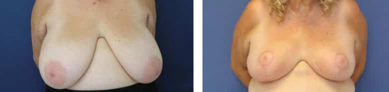 Before and After Image: Breast Reduction - front