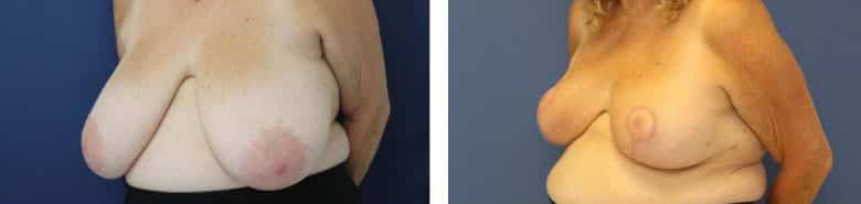 Before and After Image: Breast Reduction - left-front-oblique