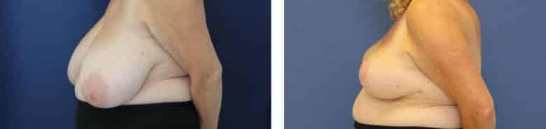 Before and After Image: Breast Reduction - left-side