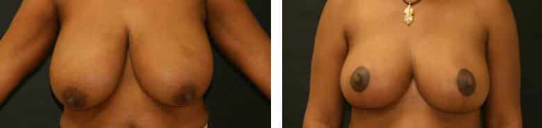 Before and After Image: Breast Reduction - front
