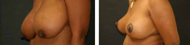 Before and After Image: Breast Reduction - left-front-oblique