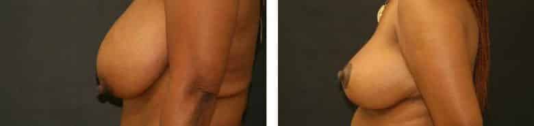 Before and After Image: Breast Reduction - left-side