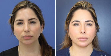 Before and After Image: Chin Augmentation - front