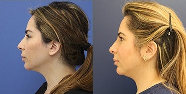 Before and After Image: Chin Augmentation - left-side
