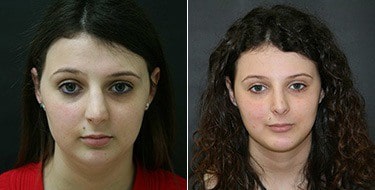Before and After Image: Chin Augmentation - front