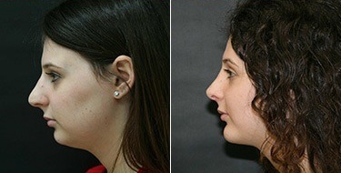 Before and After Image: Chin Augmentation - left-side