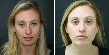 Before and After Image: Chin Augmentation - front