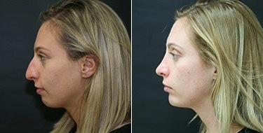 Before and After Image: Chin Augmentation - left-side