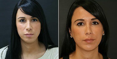 Before and After Image: Chin Augmentation - front