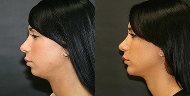 Before and After Image: Chin Augmentation - left-side