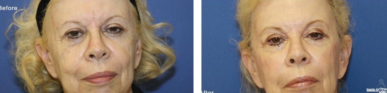 Before and After Image: Deka - front