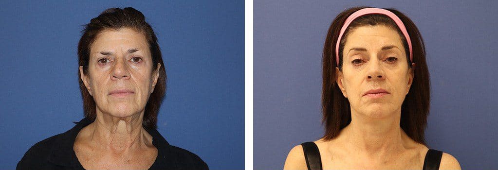 Before and After Image: Facelift - front