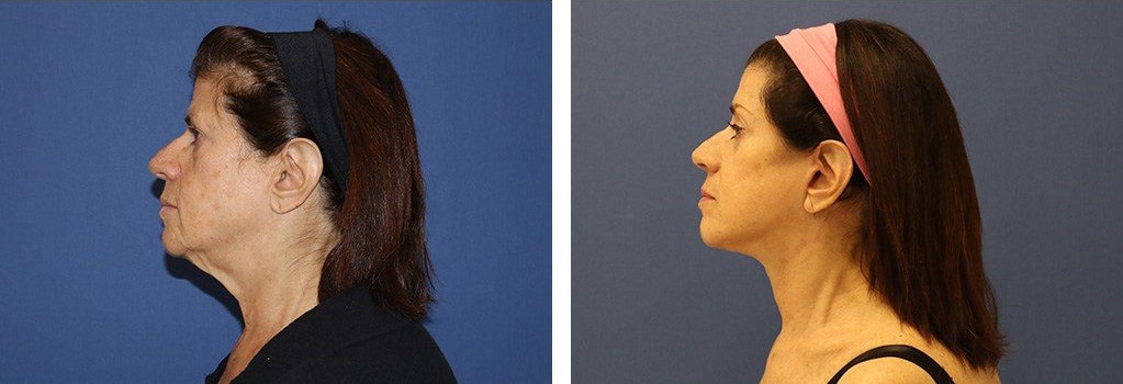 Before and After Image: Facelift - left-side