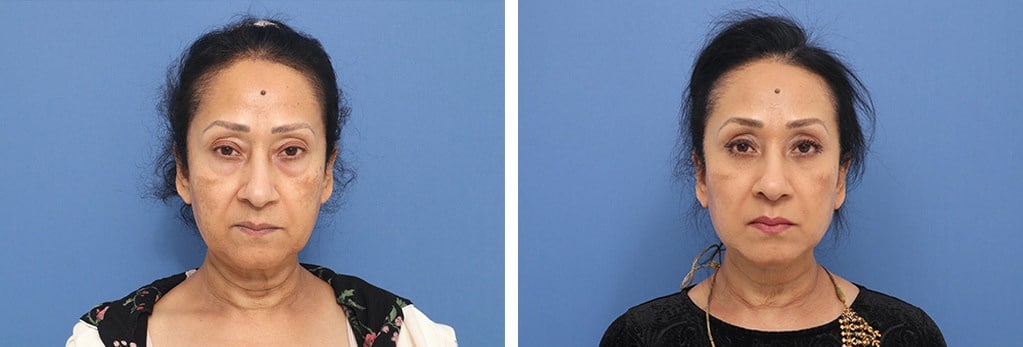 Before and After Image: Facelift - front