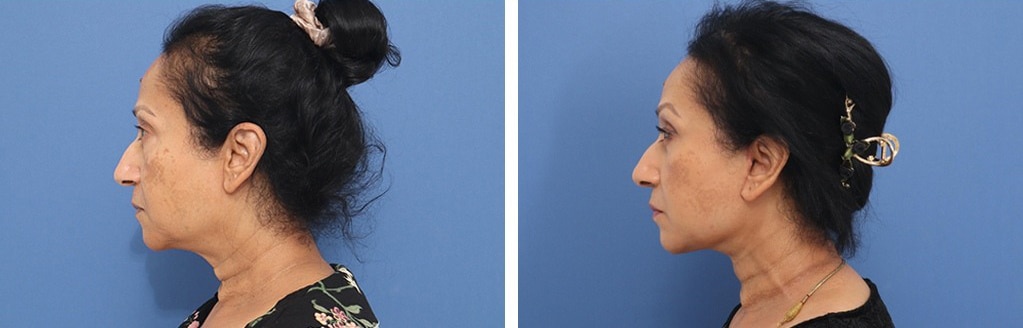 Before and After Image: Facelift - left-side