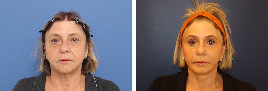 Before and After Image: Facelift - front