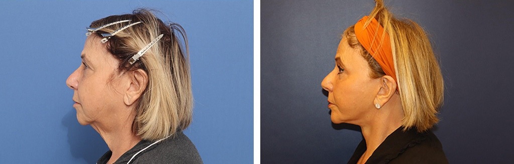 Before and After Image: Facelift - left-side