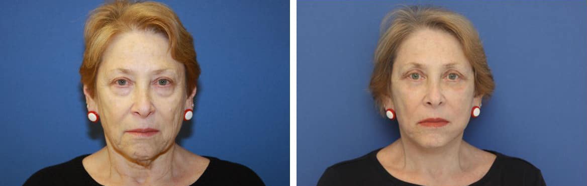 Before and After Image: Facelift - front