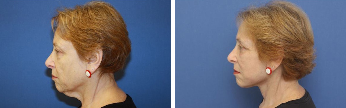 Before and After Image: Facelift - left-side