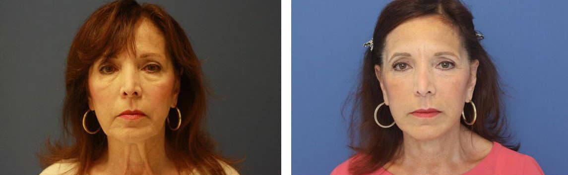 Before and After Image: Facelift - front