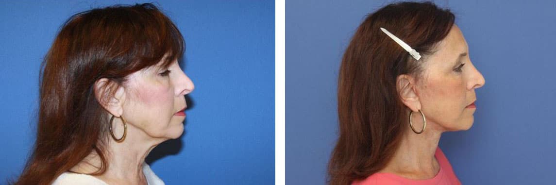 Before and After Image: Facelift - right-side