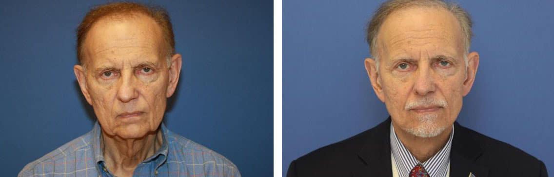 Before and After Image: Facelift - front