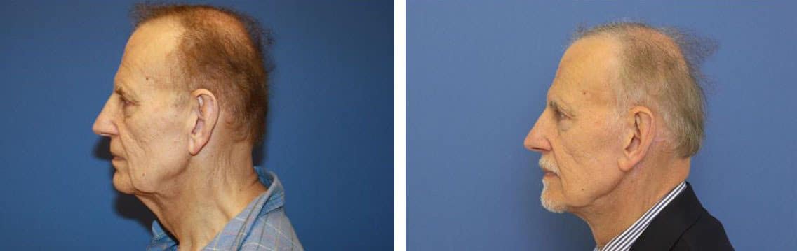 Before and After Image: Facelift - left-side