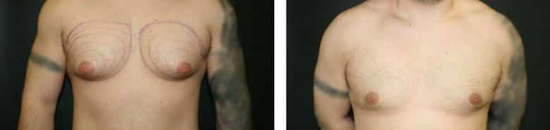 Before and After Image: Gynecomastia - front