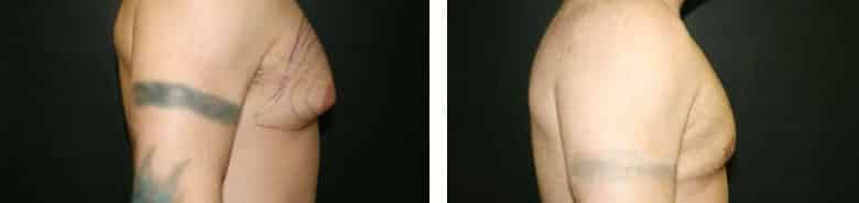 Before and After Image: Gynecomastia - right-side