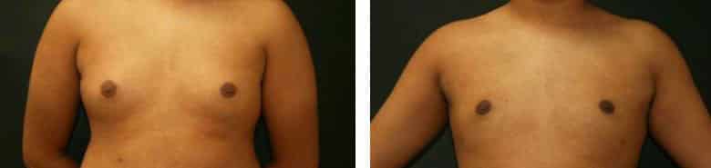 Before and After Image: Gynecomastia - front