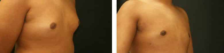 Before and After Image: Gynecomastia - right-front-oblique