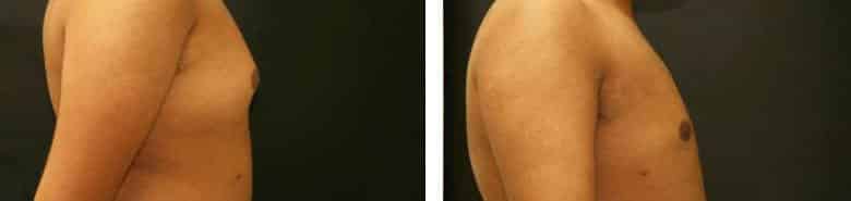 Before and After Image: Gynecomastia - right-side
