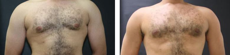Before and After Image: Gynecomastia - front