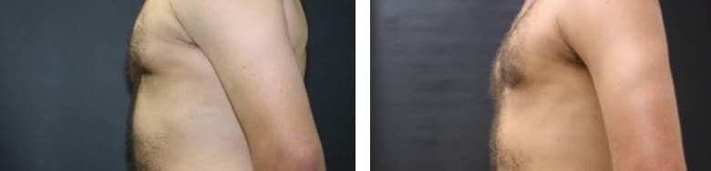 Before and After Image: Gynecomastia - left-side