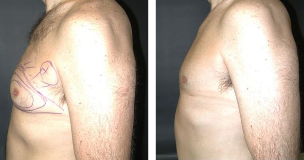 Before and After Image: Gynecomastia - left-side