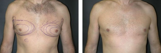 Before and After Image: Gynecomastia - front