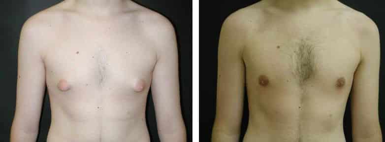 Before and After Image: Gynecomastia - front