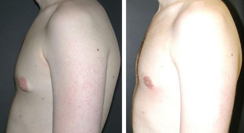 Before and After Image: Gynecomastia - left-side