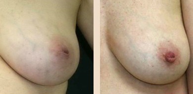 Before and After Image: Inverted Nipple Repair - front