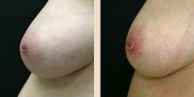 Before and After Image: Inverted Nipple Repair - left-side