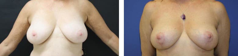 Before and After Image: Mastopexy - front