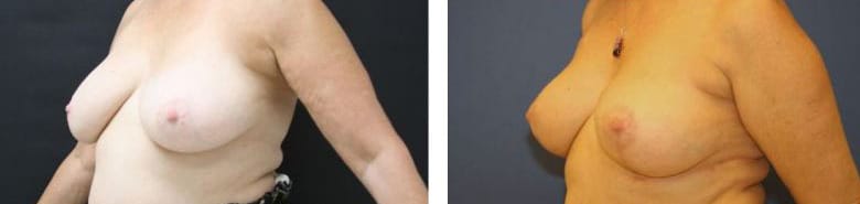 Before and After Image: Mastopexy - left-front-oblique