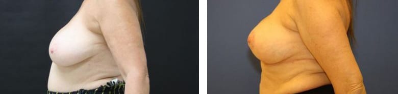 Before and After Image: Mastopexy - left-side