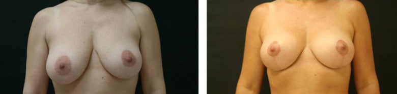 Before and After Image: Mastopexy - front