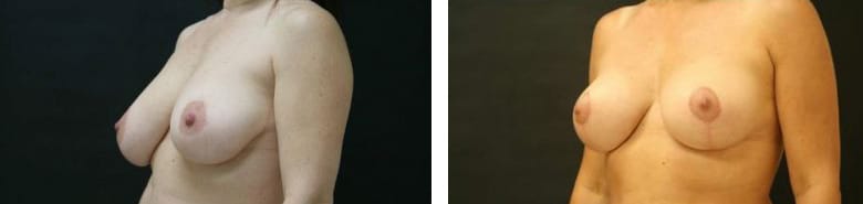 Before and After Image: Mastopexy - left-front-oblique