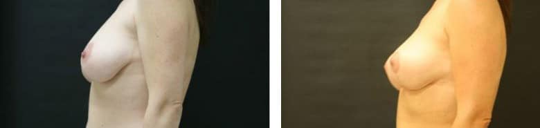 Before and After Image: Mastopexy - left-side