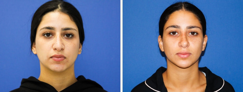 Before and After Image: Rhinoplasty - front