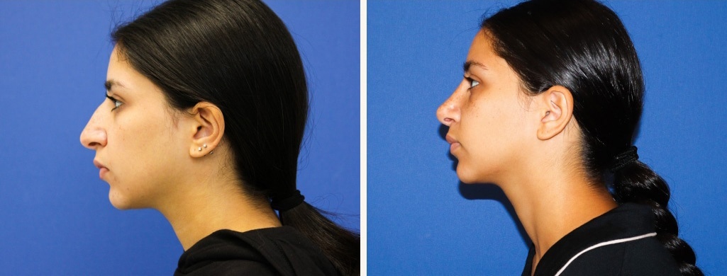 Before and After Image: Rhinoplasty - left-side