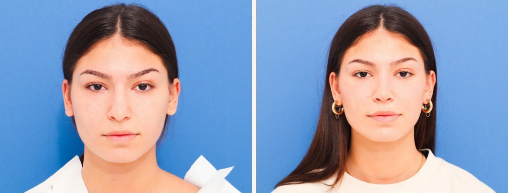 Before and After Image: Rhinoplasty - front