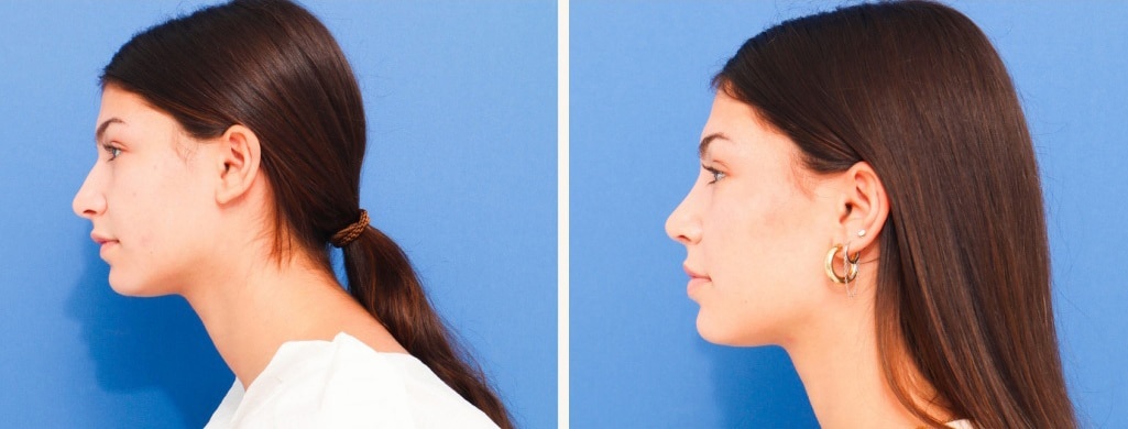 Before and After Image: Rhinoplasty - left-side